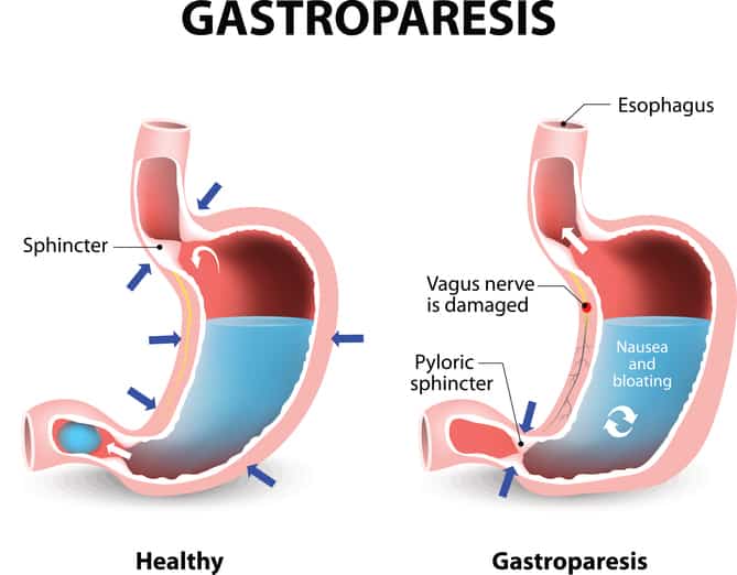 Gastroparesis diet modification